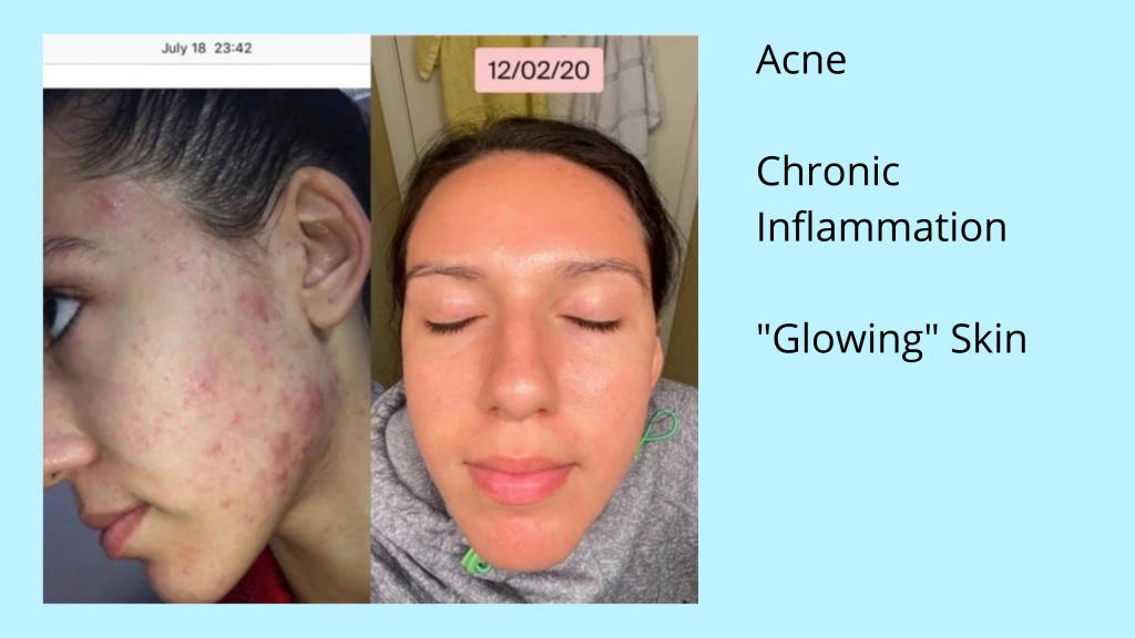 Before and after photos showing face acne and then a clear complexion.